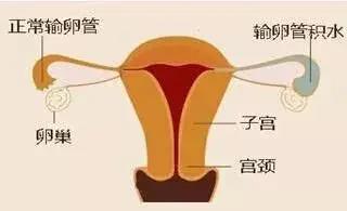 或因粘连闭锁,黏膜细胞的分泌液积存于管腔内,或因输卵管炎症发生峡部